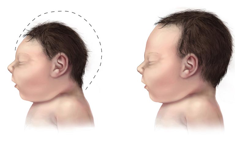 Virus-Zika-microcephaly